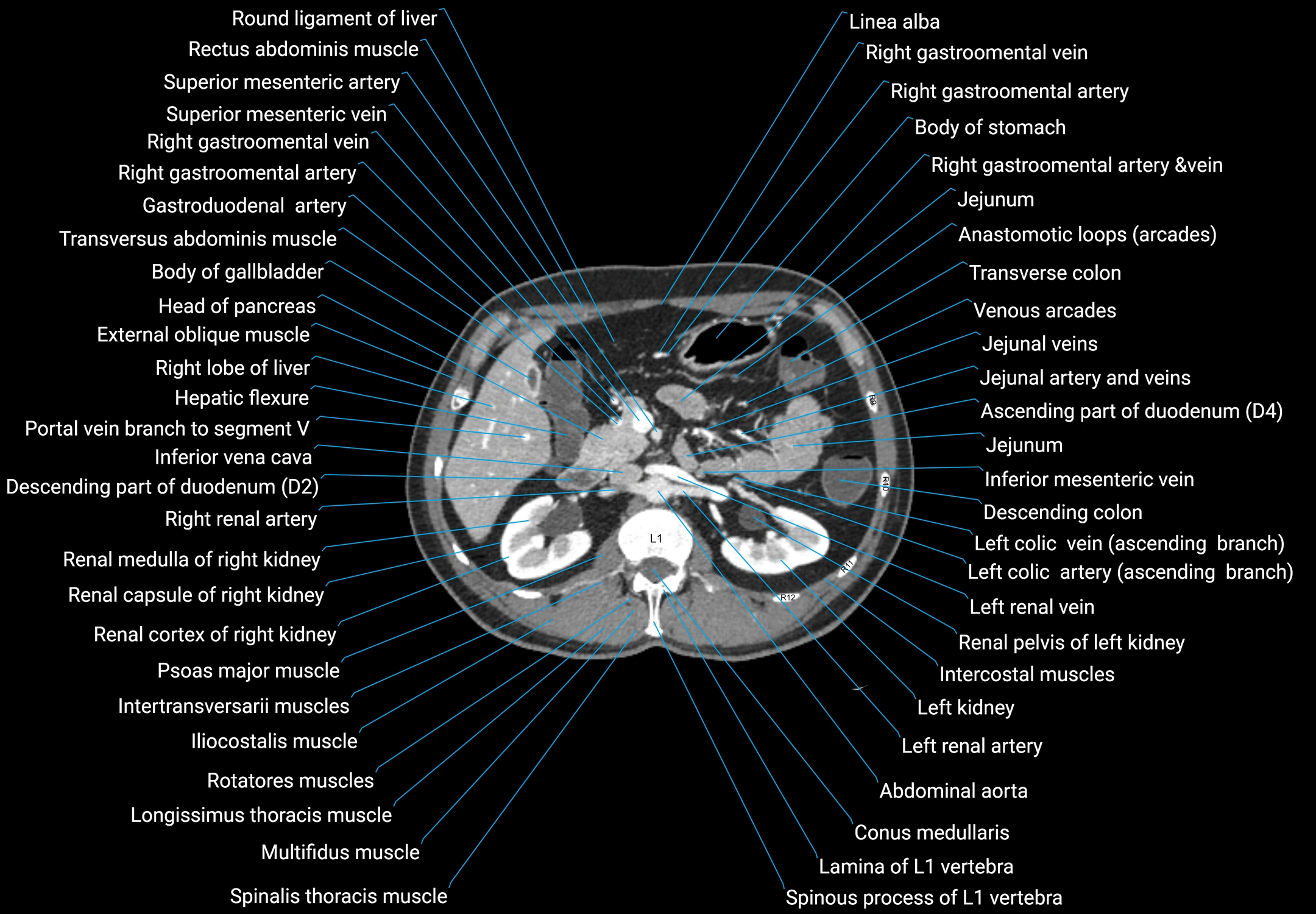 CT male pelvis axial cross sectional anatomy labelled radiology image -00062.webp